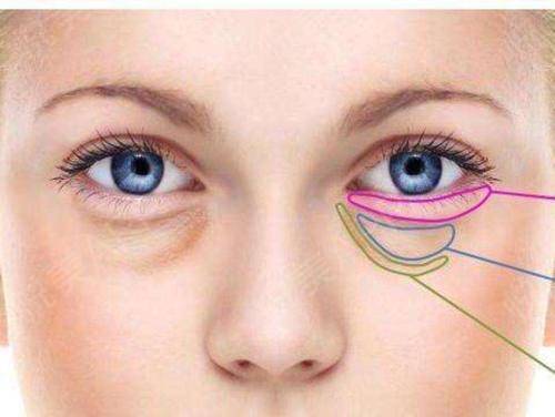 外切眼袋的過(guò)程是什么樣子的？