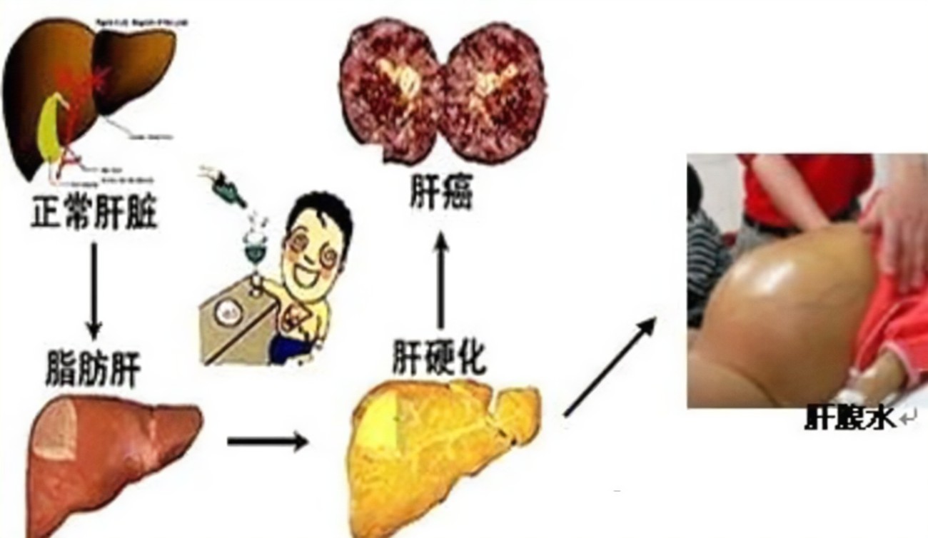 查出肝硬化還有救嗎？